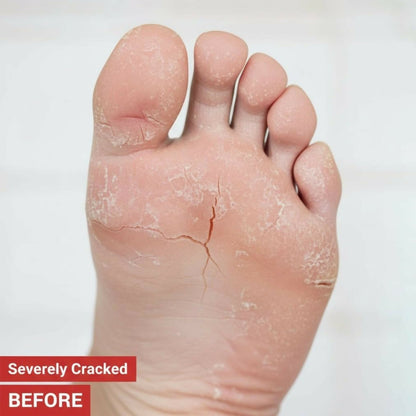 Eyelet Foot Cream for Cracked Heels & Dry Feet Deep Moisturizing Care (50Ml)